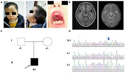 <mark class="highlighted">MN1</mark> Neurodevelopmental Disease-Atypical Phenotype Due to a Novel Frameshift Variant in the <mark class="highlighted">MN1</mark> Gene